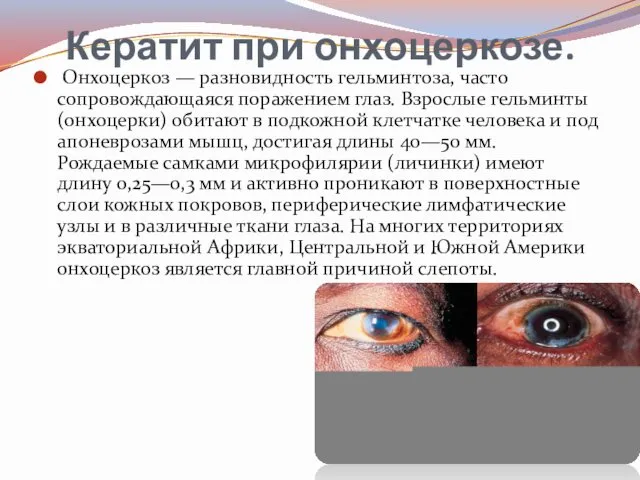 Кератит при онхоцеркозе. Онхоцеркоз — разновидность гельминтоза, часто сопровождающаяся поражением глаз. Взрослые гельминты