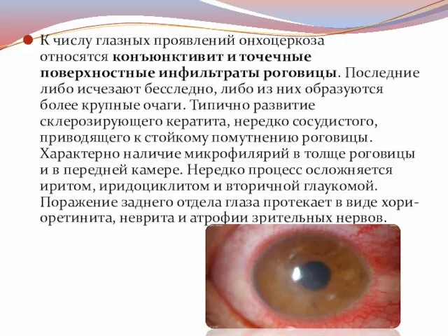 К числу глазных проявлений онхоцеркоза относятся конъюнктивит и точечные поверхностные инфильтраты роговицы. Последние