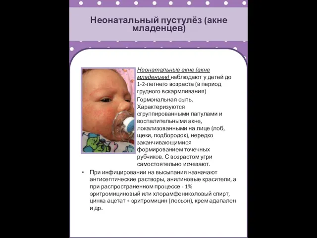Неонатальный пустулёз (акне младенцев) Неонатальные акне (акне младенцев) наблюдают у детей до 1-2-летнего