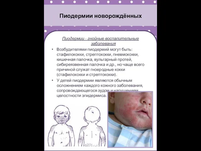 Пиодермии новорождённых Пиодермии - гнойные воспалительные заболевания Возбудителями пиодермий могут быть: стафилококки, стрептококки,