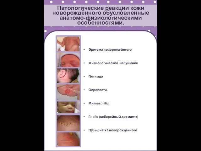 Патологические реакции кожи новорождённого обусловленные анатомо-физиологическими особенностями. Эритема новорождённого Физиологическое шелушение Потница Опрелости