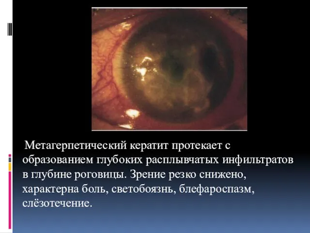 Метагерпетический кератит протекает с образованием глубоких расплывчатых инфильтратов в глубине роговицы. Зрение резко