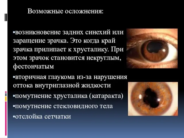 Возможные осложнения: возникновение задних синехий или заращение зрачка. Это когда край зрачка прилипает