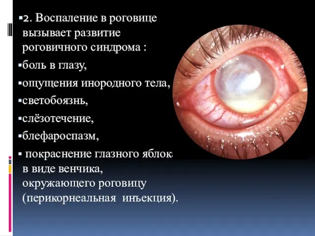 2. Воспаление в роговице вызывает развитие роговичного синдрома : боль в глазу, ощущения