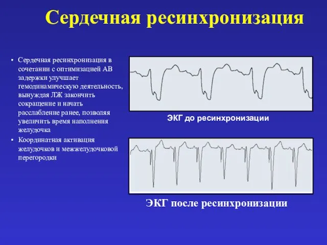 Сердечная ресинхронизация Сердечная ресинхронизация в сочетании с оптимизацией АВ задержки