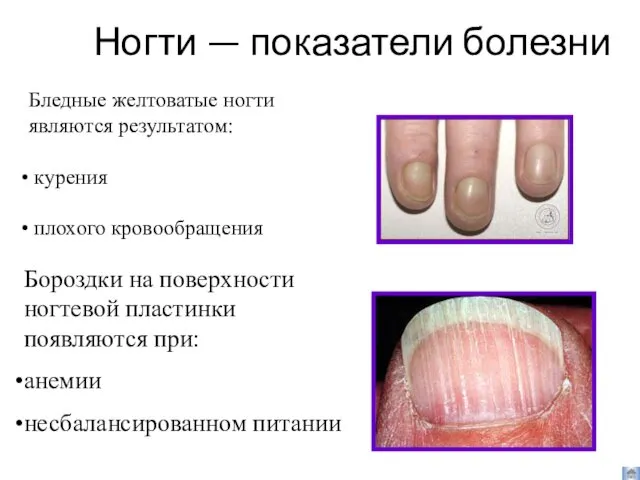 Ногти — показатели болезни Бороздки на поверхности ногтевой пластинки появляются