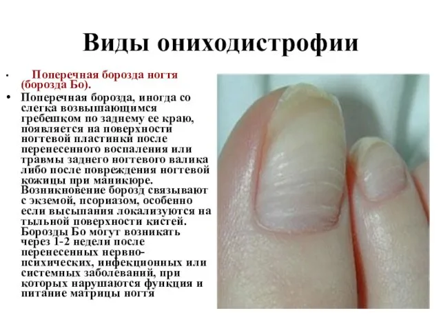 Виды ониходистрофии Поперечная борозда ногтя (борозда Бо). Поперечная борозда, иногда