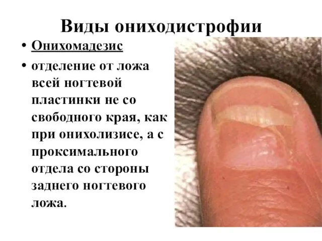Виды ониходистрофии Онихомадезис отделение от ложа всей ногтевой пластинки не