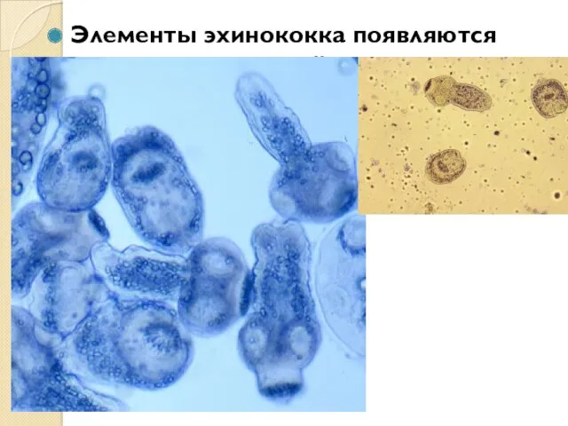 Элементы эхинококка появляются при эхинококкозе лёгких.