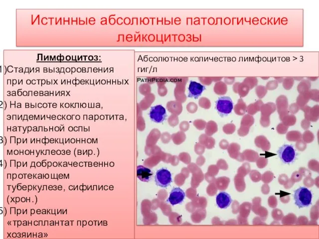 Истинные абсолютные патологические лейкоцитозы Абсолютное количество лимфоцитов ˃ 3 гиг/л