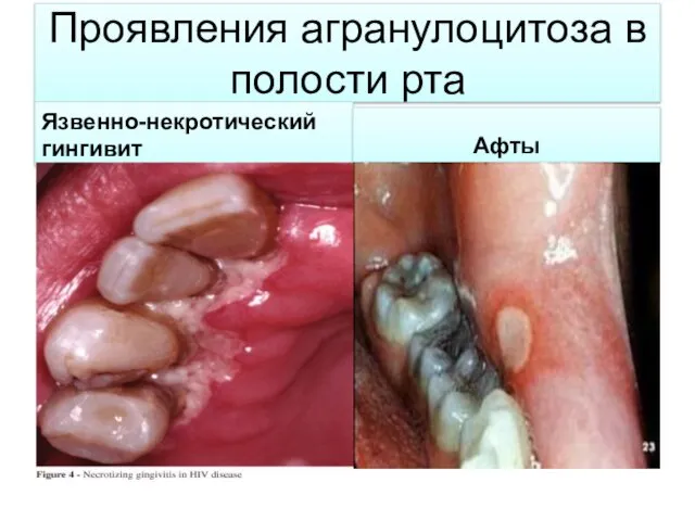 Проявления агранулоцитоза в полости рта Язвенно-некротический гингивит Афты