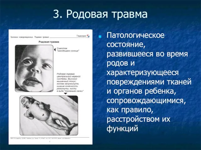 3. Родовая травма Патологическое состояние, развившееся во время родов и характеризующееся повреждениями тканей