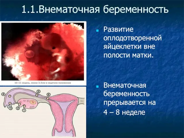 1.1.Внематочная беременность Развитие оплодотворенной яйцеклетки вне полости матки. Внематочная беременность прерывается на 4 – 8 неделе