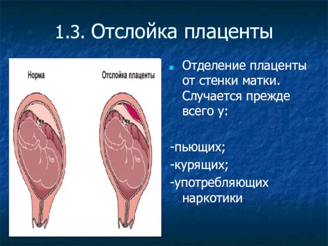 1.3. Отслойка плаценты Отделение плаценты от стенки матки. Случается прежде всего у: -пьющих; -курящих; -употребляющих наркотики