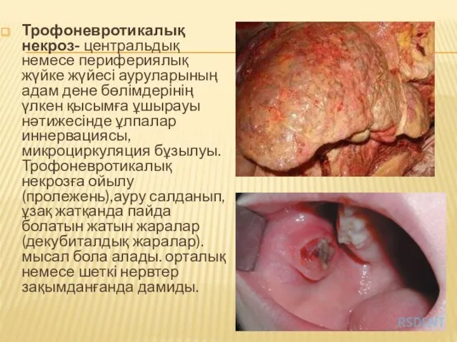 Трофоневротикалық некроз- центральдық немесе перифериялық жүйке жүйесі ауруларының адам дене бөлімдерінің үлкен қысымға