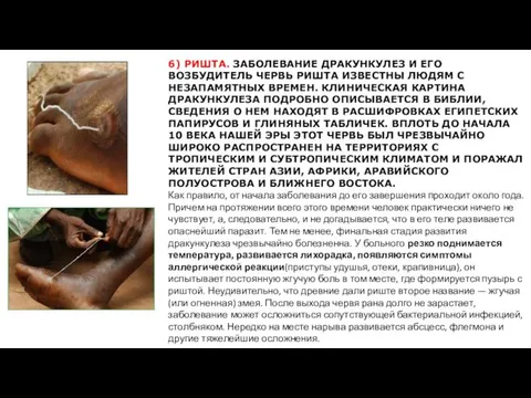 6) РИШТА. ЗАБОЛЕВАНИЕ ДРАКУНКУЛЕЗ И ЕГО ВОЗБУДИТЕЛЬ ЧЕРВЬ РИШТА ИЗВЕСТНЫ