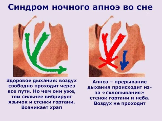 Апноэ – прерывание дыхания происходит из-за «схлопывания» стенок гортани и