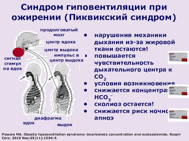 Синдром гиповентиляции при ожирении (Пиквикский синдром) нарушения механики дыхания из-за