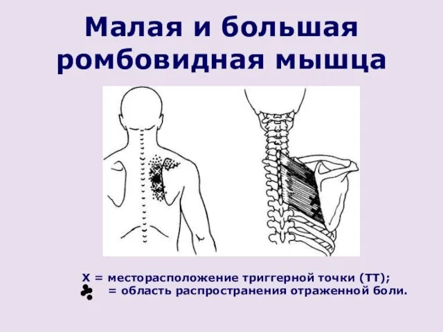 Малая и большая ромбовидная мышца X = месторасположение триггерной точки (ТТ); = область распространения отраженной боли.