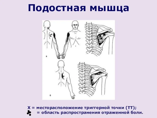 X = месторасположение триггерной точки (ТТ); = область распространения отраженной боли. Подостная мышца