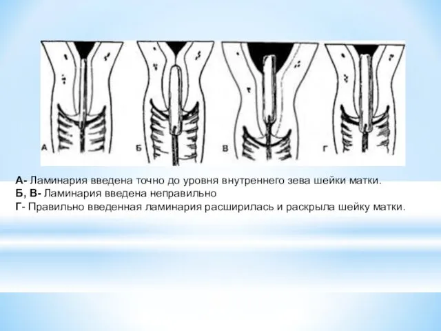 А- Ламинария введена точно до уровня внутреннего зева шейки матки.
