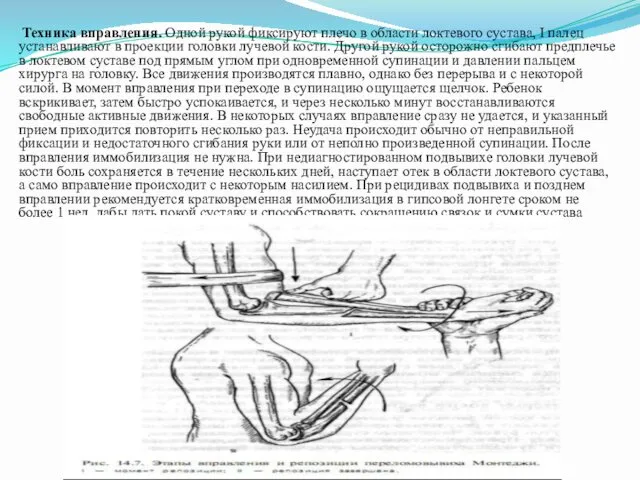 Техника вправления. Одной рукой фиксируют плечо в области локтевого сустава,