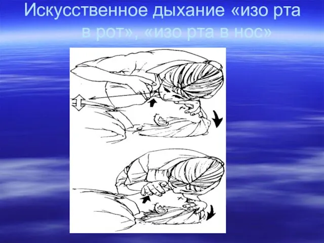 Искусственное дыхание «изо рта в рот», «изо рта в нос»