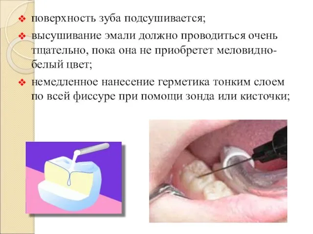 поверхность зуба подсушивается; высушивание эмали должно проводиться очень тщательно, пока