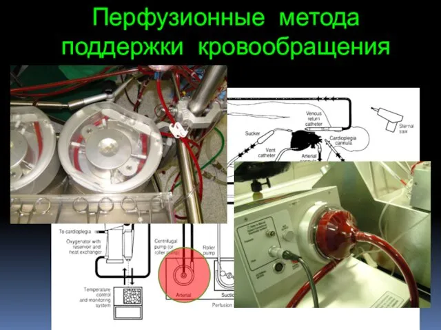 Перфузионные метода поддержки кровообращения