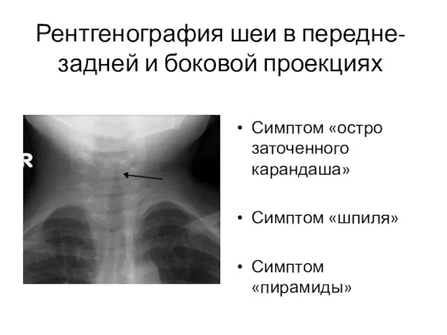 Рентгенография шеи в передне-задней и боковой проекциях Симптом «остро заточенного карандаша» Симптом «шпиля» Симптом «пирамиды»