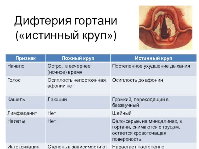 Дифтерия гортани («истинный круп»)