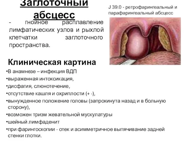 Заглоточный абсцесс Клиническая картина В анамнезе – инфекция ВДП выраженная