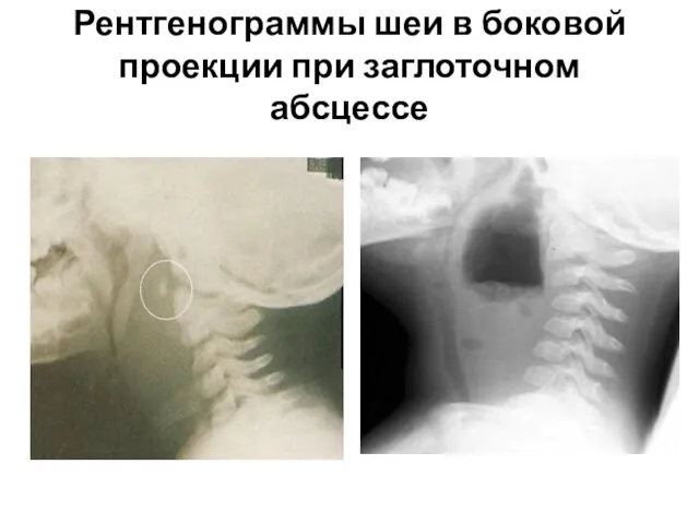 Рентгенограммы шеи в боковой проекции при заглоточном абсцессе