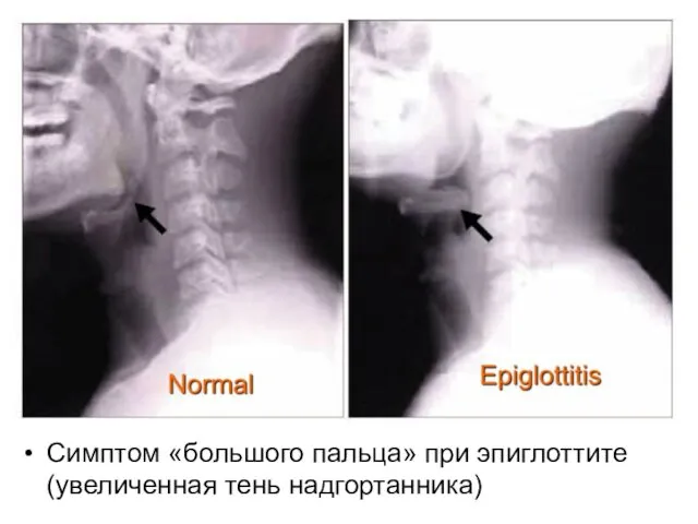 Симптом «большого пальца» при эпиглоттите (увеличенная тень надгортанника)
