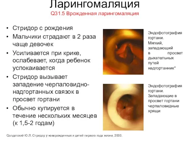 Ларингомаляция Q31.5 Врожденная ларингомаляция Стридор с рождения Мальчики страдают в