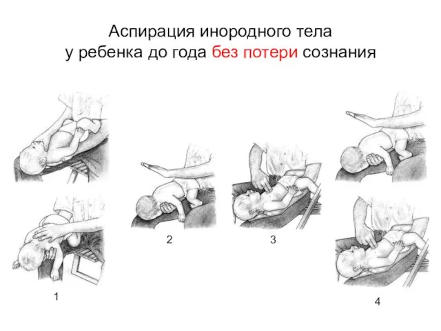 Аспирация инородного тела у ребенка до года без потери сознания 1 2 3 4