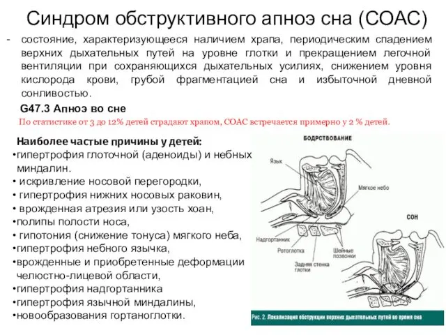 Синдром обструктивного апноэ сна (СОАС) состояние, характеризующееся наличием храпа, периодическим