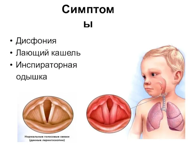 Симптомы Дисфония Лающий кашель Инспираторная одышка