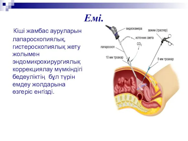 Емі. Кiшi жамбас ауруларын лапароскопиялық, гистероскопиялық жету жолымен эндомикрохирургиялық коррекциялау