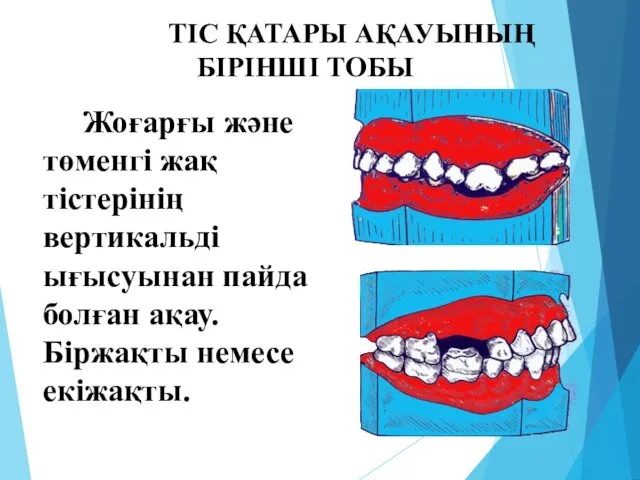 ТІС ҚАТАРЫ АҚАУЫНЫҢ БІРІНШІ ТОБЫ Жоғарғы және төменгі жақ тістерінің