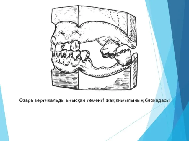 Өзара вертикальды ығысқан төменгі жақ қимылының блокадасы