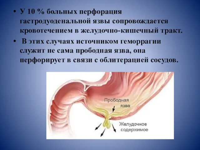 У 10 % больных перфорация гастродуоденальной язвы сопровождается кровотечением в