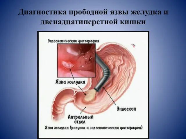 Диагностика прободной язвы желудка и двенадцатиперстной кишки