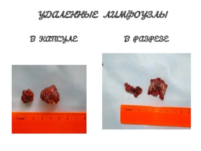 УДАЛЕННЫЕ ЛИМФОУЗЛЫ В КАПСУЛЕ В РАЗРЕЗЕ