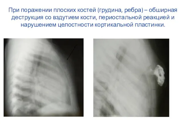 При поражении плоских костей (грудина, ребра) – обширная деструкция со