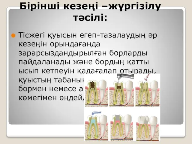 Бірінші кезеңі –жүргізілу тәсілі: Тісжегі қуысын егеп-тазалаудың әр кезеңін орындағанда