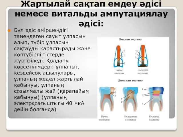 Жартылай сақтап емдеу әдісі немесе витальды ампутациялау әдісі: Бұл әдіс