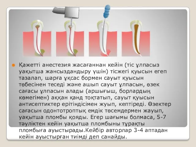 Қажетті анестезия жасағаннан кейін (тіс ұлпасыз уақытша жансыздандыру үшін) тісжегі