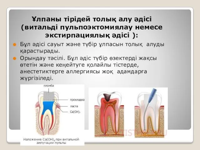 Ұлпаны тірідей толық алу әдісі (витальді пульпоэктомиялау немесе экстирпациялық әдісі