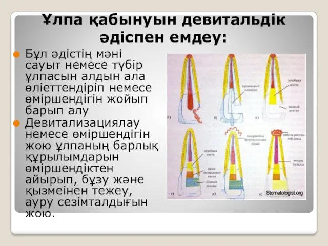 Ұлпа қабынуын девитальдік әдіспен емдеу: Бұл әдістің мәні сауыт немесе